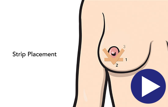 How To Use Scar Angel After A Breast Augmentation Video