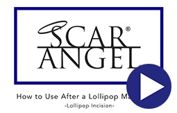 How To Use Scar Angel On A Lollipop Incision Video