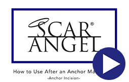 How To Use Scar Angel On An Anchor Incision Video
