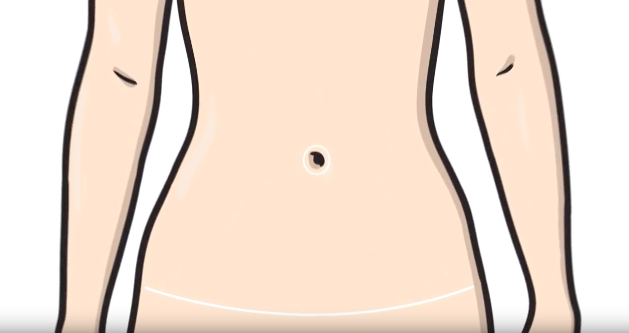 How To Use Scar Angel After A Tummy Tuck Video